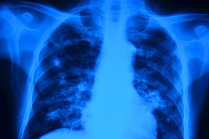 Lungs