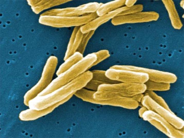 Tuberculosis